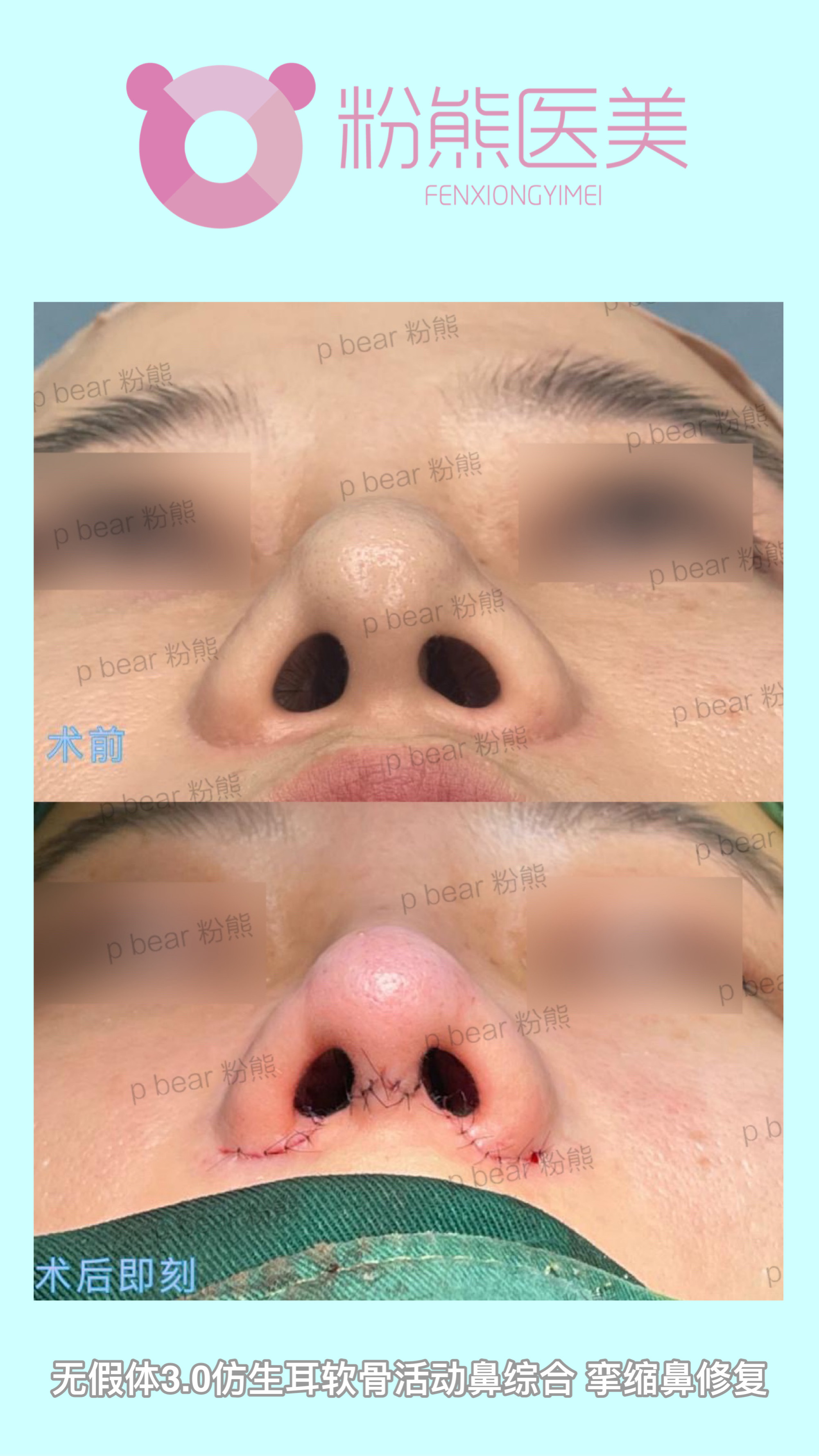 鼻梁压条最新步骤指南详解